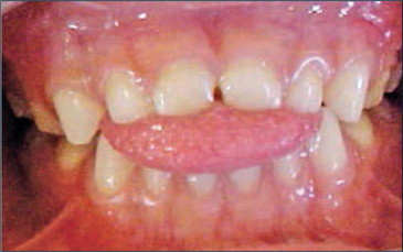 Paciente-con-interposicion-lingual-en-denticion-temporal-que-muestra-mordida-abierta